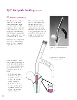 Preview for 37 page of Synthes The Titanium Femoral Nail System Technique Manual