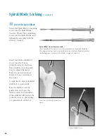 Preview for 47 page of Synthes The Titanium Femoral Nail System Technique Manual