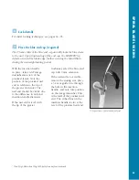 Preview for 50 page of Synthes The Titanium Femoral Nail System Technique Manual