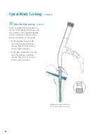 Preview for 51 page of Synthes The Titanium Femoral Nail System Technique Manual