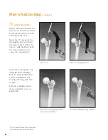 Preview for 61 page of Synthes The Titanium Femoral Nail System Technique Manual