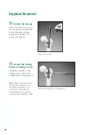 Preview for 67 page of Synthes The Titanium Femoral Nail System Technique Manual