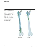 Preview for 7 page of Synthes Titanium Trochanteric Fixation
Nail System Technique Manual