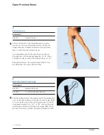 Preview for 9 page of Synthes Titanium Trochanteric Fixation
Nail System Technique Manual