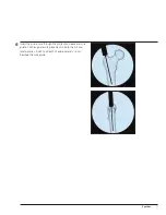 Preview for 13 page of Synthes Titanium Trochanteric Fixation
Nail System Technique Manual