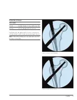 Preview for 31 page of Synthes Titanium Trochanteric Fixation
Nail System Technique Manual