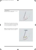 Preview for 19 page of Synthes USS II Polyaxial Technique Manual