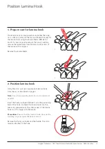 Preview for 13 page of Synthes USS Small Stature/Paediatric Spine System Manual