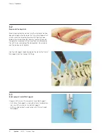 Preview for 24 page of Synthes VEPTR Technical Manual