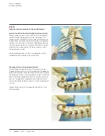 Preview for 34 page of Synthes VEPTR Technical Manual