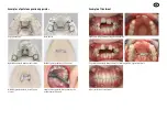 Preview for 9 page of Tiger Dental PowerScrew 12 Instructions For Use Manual