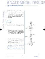 Preview for 4 page of Tornier Latitude Manual