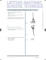 Preview for 11 page of Tornier Latitude Manual