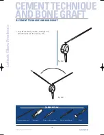 Preview for 36 page of Tornier Latitude Manual