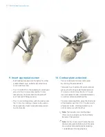 Preview for 24 page of Zimmer Biomet A.L.P.S. Surgical Technique