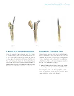 Preview for 5 page of Zimmer Biomet Arcos Modular FemoralRevision System Surgical Technique