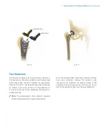 Preview for 9 page of Zimmer Biomet Arcos Modular FemoralRevision System Surgical Technique