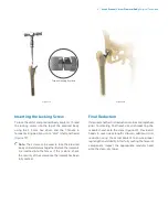 Preview for 11 page of Zimmer Biomet Arcos Modular FemoralRevision System Surgical Technique