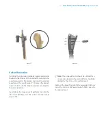 Preview for 15 page of Zimmer Biomet Arcos Modular FemoralRevision System Surgical Technique