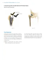 Preview for 16 page of Zimmer Biomet Arcos Modular FemoralRevision System Surgical Technique