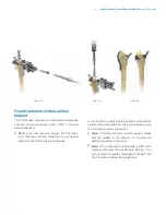 Preview for 23 page of Zimmer Biomet Arcos Modular FemoralRevision System Surgical Technique