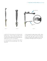 Preview for 31 page of Zimmer Biomet Arcos Modular FemoralRevision System Surgical Technique