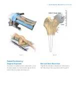 Предварительный просмотр 5 страницы Zimmer Biomet Avenir Complete Hip System Surgical Technique