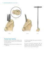 Предварительный просмотр 6 страницы Zimmer Biomet Avenir Complete Hip System Surgical Technique