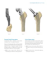 Предварительный просмотр 7 страницы Zimmer Biomet Avenir Complete Hip System Surgical Technique