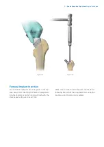 Предварительный просмотр 9 страницы Zimmer Biomet Avenir Complete Hip System Surgical Technique