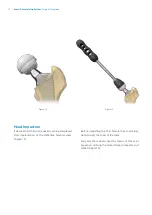 Предварительный просмотр 10 страницы Zimmer Biomet Avenir Complete Hip System Surgical Technique