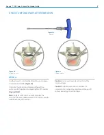 Preview for 7 page of Zimmer Biomet Avenue T Surgical Technique Manual