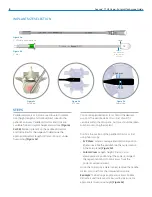 Preview for 8 page of Zimmer Biomet Avenue T Surgical Technique Manual