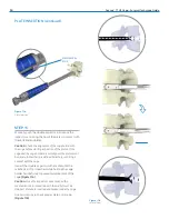 Preview for 14 page of Zimmer Biomet Avenue T Surgical Technique Manual