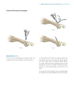 Предварительный просмотр 15 страницы Zimmer Biomet Headless Compression
and Twist-Off Screws Surgical Technique