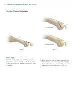 Предварительный просмотр 16 страницы Zimmer Biomet Headless Compression
and Twist-Off Screws Surgical Technique