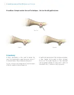 Предварительный просмотр 6 страницы Zimmer Biomet Headless Compressionand Twist-Off Screws Surgical Technique