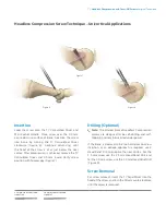 Предварительный просмотр 9 страницы Zimmer Biomet Headless Compressionand Twist-Off Screws Surgical Technique