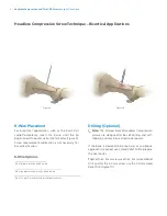 Предварительный просмотр 10 страницы Zimmer Biomet Headless Compressionand Twist-Off Screws Surgical Technique