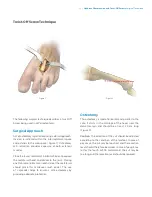 Предварительный просмотр 13 страницы Zimmer Biomet Headless Compressionand Twist-Off Screws Surgical Technique