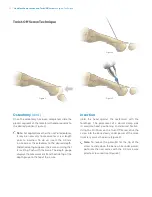 Предварительный просмотр 14 страницы Zimmer Biomet Headless Compressionand Twist-Off Screws Surgical Technique