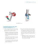 Preview for 37 page of Zimmer Biomet iASSIST Knee Manual