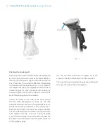 Preview for 20 page of Zimmer Biomet NexGen MIS LPS-Flex Surgical Technique Manual