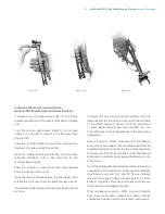 Preview for 49 page of Zimmer Biomet NexGen MIS LPS-Flex Surgical Technique Manual