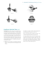 Preview for 51 page of Zimmer Biomet NexGen MIS LPS-Flex Surgical Technique Manual