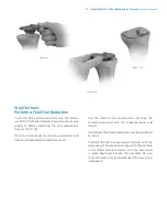 Preview for 61 page of Zimmer Biomet NexGen MIS LPS-Flex Surgical Technique Manual