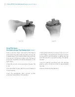 Preview for 62 page of Zimmer Biomet NexGen MIS LPS-Flex Surgical Technique Manual