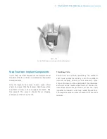 Preview for 63 page of Zimmer Biomet NexGen MIS LPS-Flex Surgical Technique Manual