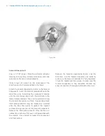 Preview for 64 page of Zimmer Biomet NexGen MIS LPS-Flex Surgical Technique Manual