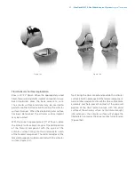 Preview for 65 page of Zimmer Biomet NexGen MIS LPS-Flex Surgical Technique Manual